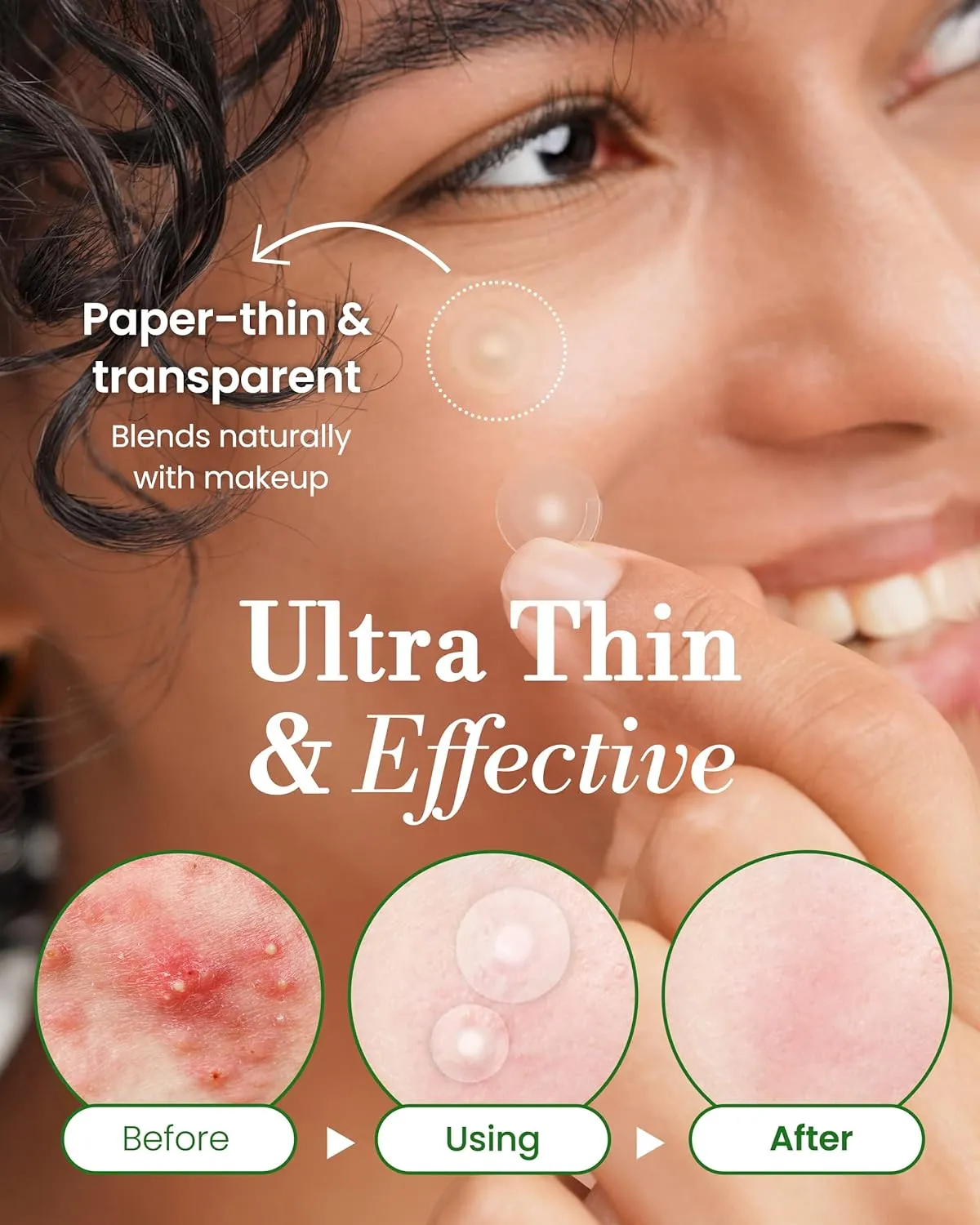 Troubless Invisible Pimple Spot Patch - The Classic
