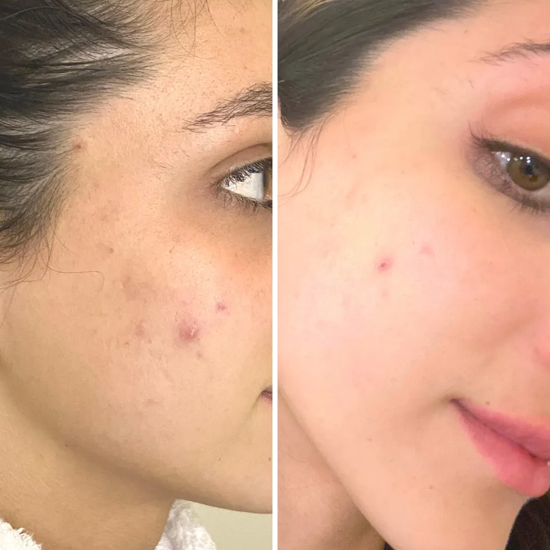 Yon-Ka SOS Spot Roll-On Blemish Treatment
